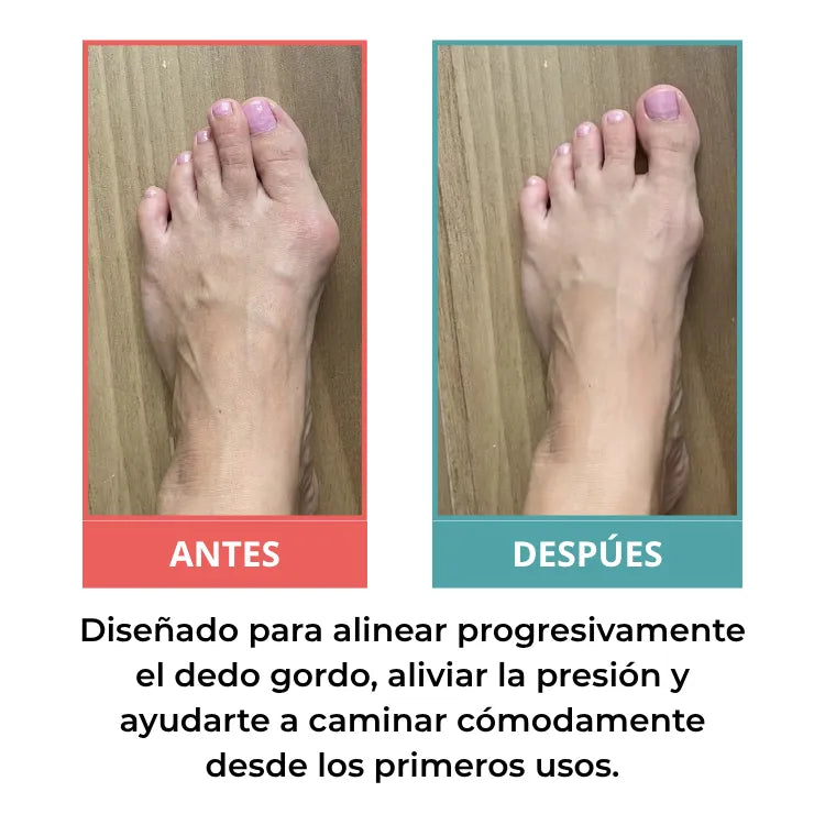 Corrector de juanete - Vuelve a Caminar Sin Dolor ni Cirugías Costosas Alivio Premium